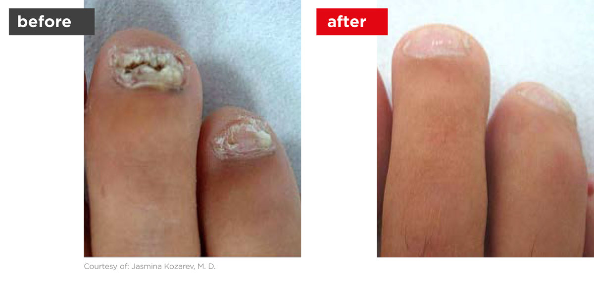 ClearSteps-Before_After-2