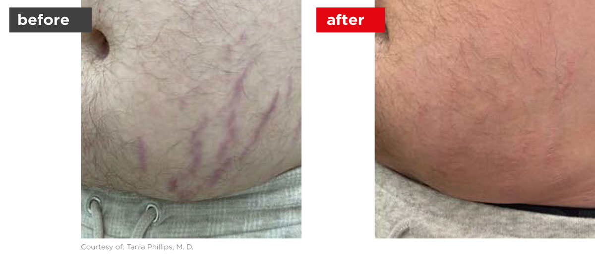 Scars-Stretchmarks-Before_Afters-2