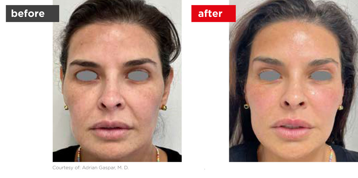 VectorLift-Before_After-2